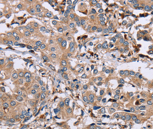 Immunohistochemistry of paraffin-embedded Human liver cancer using MAGEA3 Polyclonal Antibody at dilution of 1:50