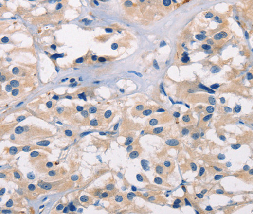 Immunohistochemistry of paraffin-embedded Human thyroid cancer tissue using ADGRB1 Polyclonal Antibody at dilution 1:40