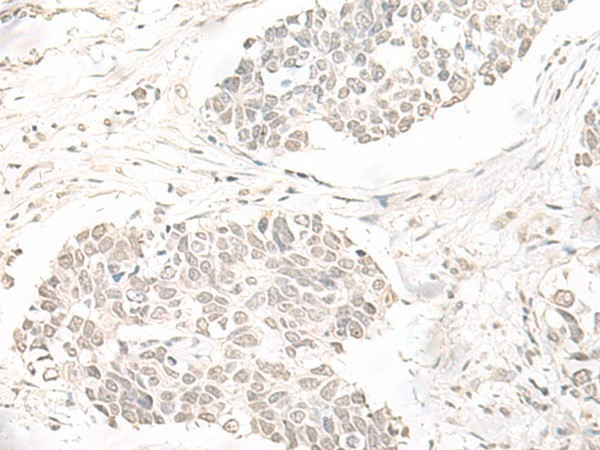 Immunohistochemistry of paraffin-embedded Human lung cancer tissue  using ILKAP Polyclonal Antibody at dilution of 1:50(?200)