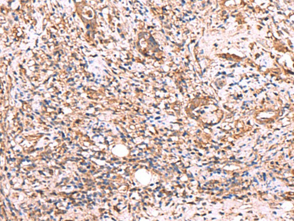 Immunohistochemistry of paraffin-embedded Human cervical cancer tissue  using TTC38 Polyclonal Antibody at dilution of 1:50(?200)