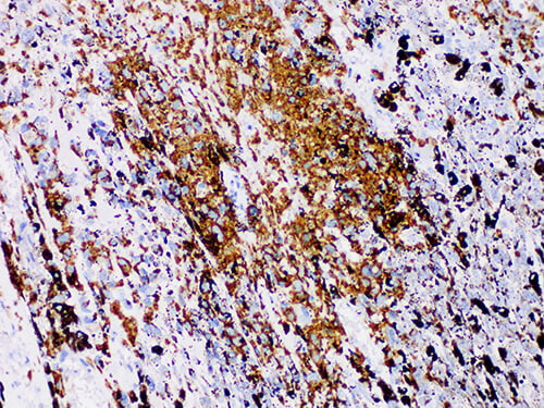 Immunohistochemistry of paraffinembedded Human melanoma tissue with S100P Monoclonal Antibody(Antigen repaired by EDTA).