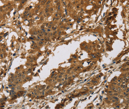 Immunohistochemistry of paraffin-embedded Human gastric cancer tissue using IL19 Polyclonal Antibody at dilution 1:40