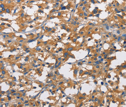 Immunohistochemistry of paraffin-embedded Human thyroid cancer tissue using CD73 Polyclonal Antibody at dilution 1:50