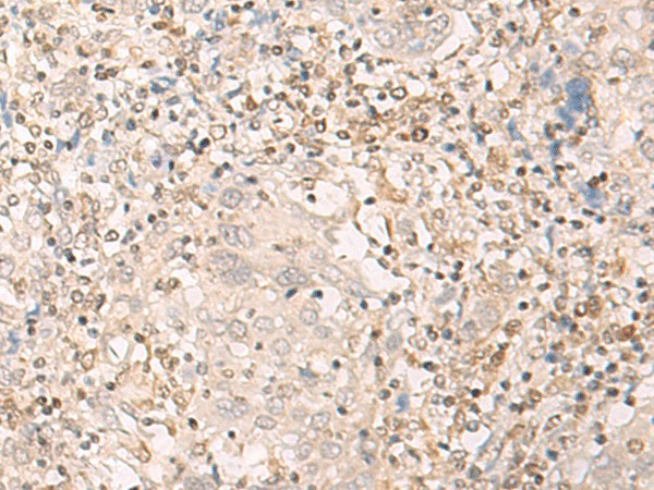 Immunohistochemistry of paraffin-embedded Human cervical cancer tissue  using EPSTI1 Polyclonal Antibody at dilution of 1:25(?200)