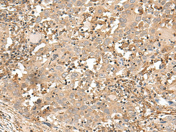 Immunohistochemistry of paraffin-embedded Human cervical cancer tissue  using FSTL5 Polyclonal Antibody at dilution of 1:50(?200)