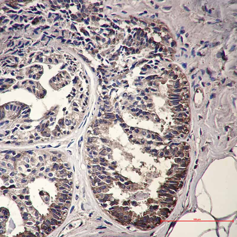 Immunohistochemistry of IMPDH2 in paraffin-embedded Human breast cancer tissue using IMPDH2 Rabbit mAb at dilution 1:50