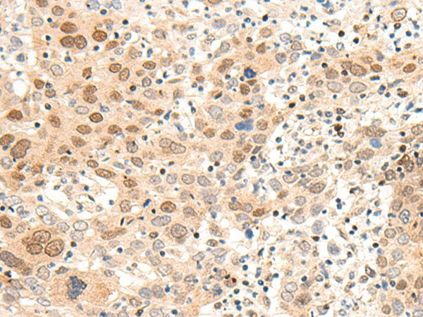 Immunohistochemistry of paraffin-embedded Human cervical cancer tissue  using ARMC8 Polyclonal Antibody at dilution of 1:60(?200)