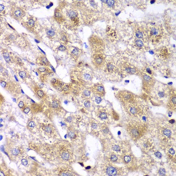 Immunohistochemistry of paraffin-embedded Human liver damage using RPS10 Polyclonal Antibody at dilution of 1:100 (40x lens).