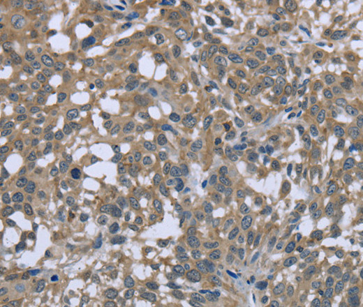 Immunohistochemistry of paraffin-embedded Human cervical cancer using PTK2B Polyclonal Antibody at dilution of 1:50