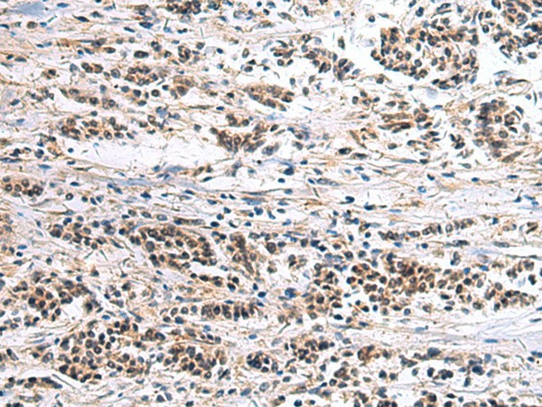 Immunohistochemistry of paraffin-embedded Human breast cancer tissue  using CLCN7 Polyclonal Antibody at dilution of 1:105(?200)