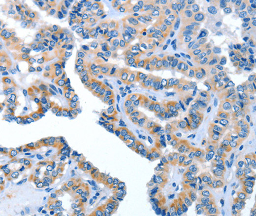 Immunohistochemistry of paraffin-embedded Human thyroid cancer using AMDHD2 Polyclonal Antibody at dilution of 1:40