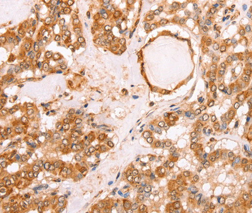 Immunohistochemistry of paraffin-embedded Human thyroid cancer tissue using TAX1BP1 Polyclonal Antibody at dilution 1:40