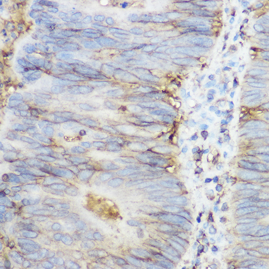 Immunohistochemistry of paraffin-embedded human colon carcinoma using beta 2 Microglobulin Polyclonal Antibody at dilution of 1:250 (40x lens).Perform high pressure antigen retrieval with 10 mM citrate buffer pH 6.0 before commencing with IHC staining protocol.