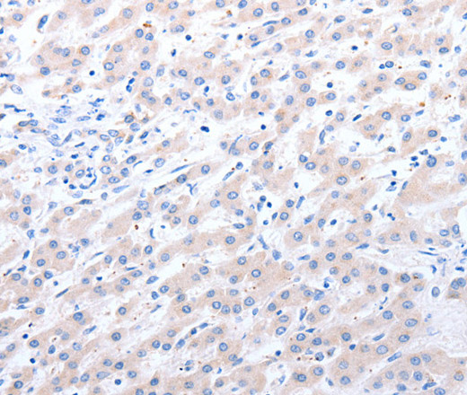 Immunohistochemistry of paraffin-embedded Human liver cancer using ALDH1A1/2/3 Polyclonal Antibody at dilution of 1:40