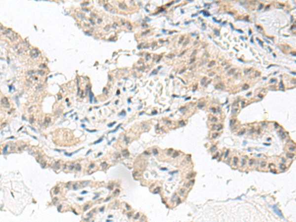 Immunohistochemistry of paraffin-embedded Human thyroid cancer tissue  using GFI1B Polyclonal Antibody at dilution of 1:80(?200)