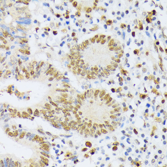 Immunohistochemistry of paraffin-embedded human colon carcinoma using ELAC2 Polyclonal antibody at dilution of 1:200 (40x lens).Perform microwave antigen retrieval with 10 mM PBS buffer pH 7.2 before commencing with IHC staining protocol.