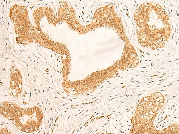 Immunohistochemistry of paraffin-embedded Human breast cancer tissue  using ZNF580 Polyclonal Antibody at dilution of 1:75(?200)