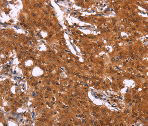 Immunohistochemistry of paraffin-embedded Human gastric cancer using APMAP Polyclonal Antibody at dilution of 1:30