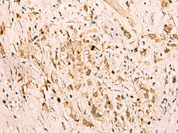 Immunohistochemistry of paraffin-embedded Human gastric cancer tissue  using SGTA Polyclonal Antibody at dilution of 1:75(?200)