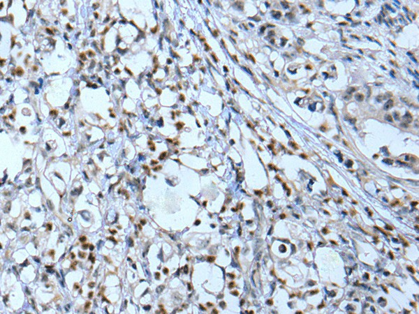 Immunohistochemistry of paraffin-embedded Human gastric cancer tissue  using NF1 Polyclonal Antibody at dilution of 1:65(?200)