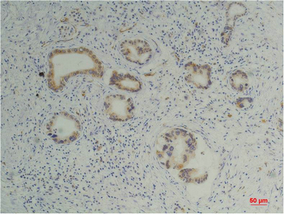 Immunohistochemistry of paraffin-embedded Human pancreas carcinoma tissue using PPIB Monoclonal Antibody at dilution of 1:200.