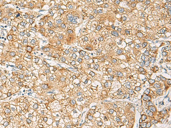 Immunohistochemistry of paraffin-embedded Human liver cancer tissue  using CRABP1 Polyclonal Antibody at dilution of 1:120(?200)