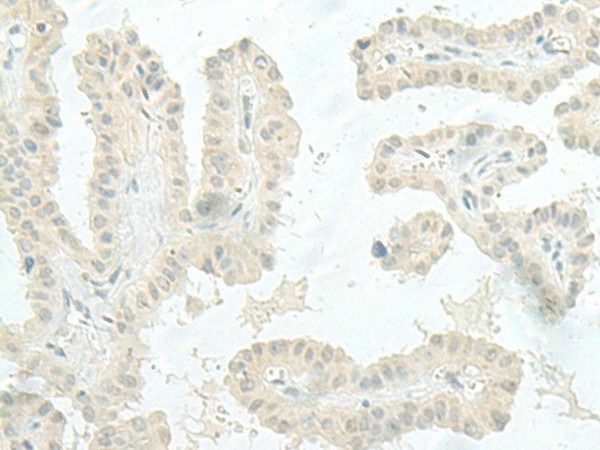 Immunohistochemistry of paraffin-embedded Human thyroid cancer tissue  using MIEN1 Polyclonal Antibody at dilution of 1:45(?200)