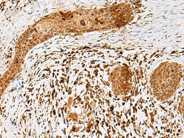 Immunohistochemistry of paraffin-embedded Human esophagus cancer tissue  using SCRN2 Polyclonal Antibody at dilution of 1:50(?200)