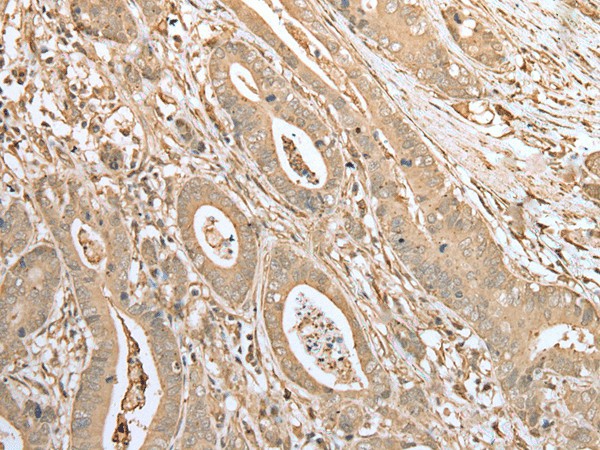 Immunohistochemistry of paraffin-embedded Human gastric cancer tissue  using FNDC3B Polyclonal Antibody at dilution of 1:45(?200)