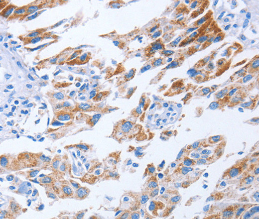 Immunohistochemistry of paraffin-embedded Human lung cancer using KIF3A Polyclonal Antibody at dilution of 1:40