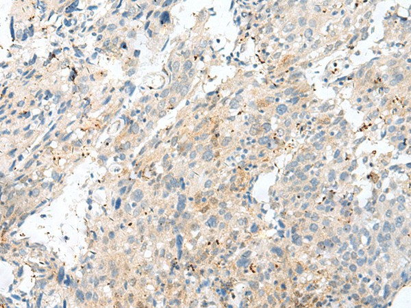 Immunohistochemistry of paraffin-embedded Human cervical cancer tissue  using NXNL1 Polyclonal Antibody at dilution of 1:45(?200)