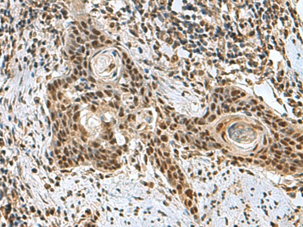 Immunohistochemistry of paraffin-embedded Human esophagus cancer tissue  using PRPF40A Polyclonal Antibody at dilution of 1:60(?200)