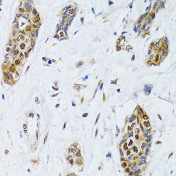 Immunohistochemistry of paraffin-embedded Human breast cancer using CIRBP Polyclonal Antibody at dilution of 1:100 (40x lens).
