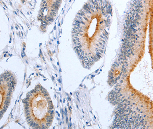 Immunohistochemistry of paraffin-embedded Human colon cancer using PLAUR Polyclonal Antibody at dilution of 1:50