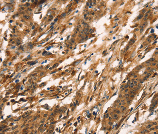 Immunohistochemistry of paraffin-embedded Human gastric cancer tissue using CD159a/c Polyclonal Antibody at dilution 1:30