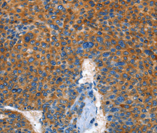 Immunohistochemistry of paraffin-embedded Human liver cancer using AUP1 Polyclonal Antibody at dilution of 1:50