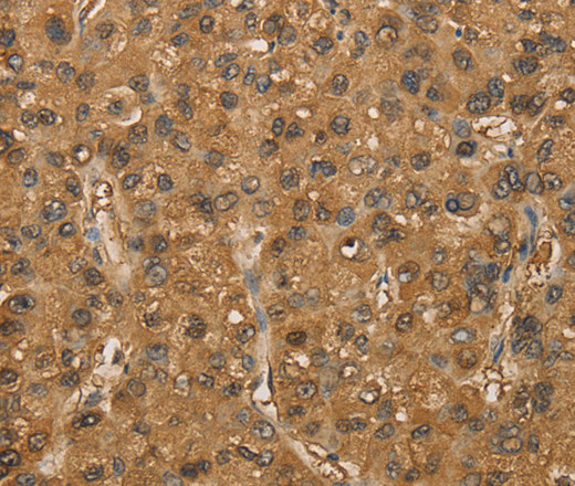 Immunohistochemistry of paraffin-embedded Human liver cancer tissue using SETD2 Polyclonal Antibody at dilution 1:30