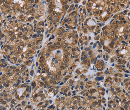 Immunohistochemistry of paraffin-embedded Human thyroid cancer using GALK1 Polyclonal Antibody at dilution of 1:40