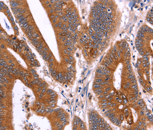 Immunohistochemistry of paraffin-embedded Human colon cancer tissue using CRISP3 Polyclonal Antibody at dilution 1:40