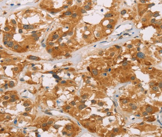 Immunohistochemistry of paraffin-embedded Human thyroid cancer tissue using DLL4 Polyclonal Antibody at dilution 1:40