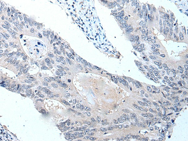 Immunohistochemistry of paraffin-embedded Human colorectal cancer tissue  using VPS35 Polyclonal Antibody at dilution of 1:25(?200)