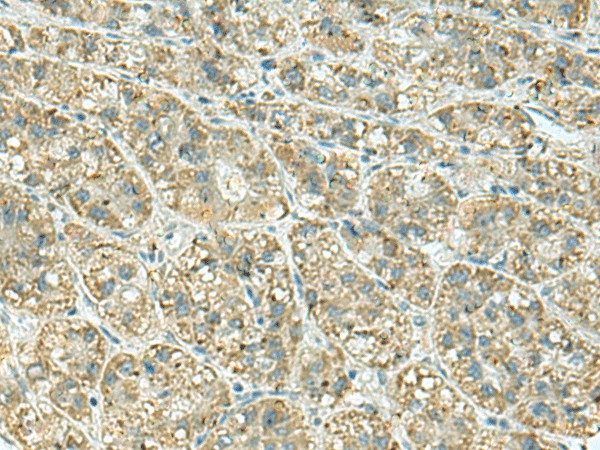 Immunohistochemistry of paraffin-embedded Human liver cancer tissue  using JPH1 Polyclonal Antibody at dilution of 1:30(?200)