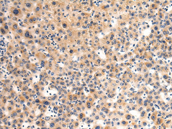 Immunohistochemistry of paraffin-embedded Human liver cancer tissue  using GLT8D1 Polyclonal Antibody at dilution of 1:90(?200)