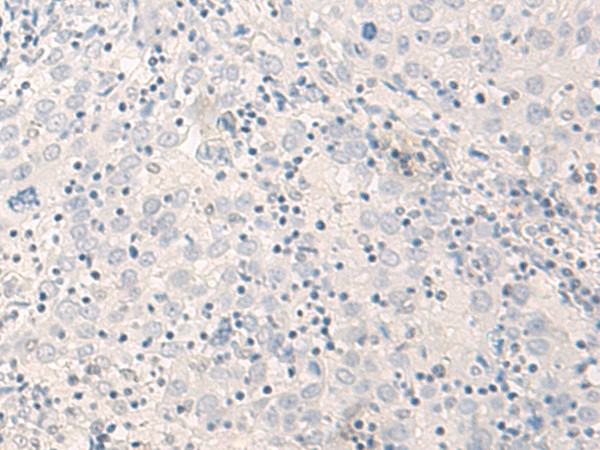 Immunohistochemistry of paraffin-embedded Human cervical cancer tissue  using THOP1 Polyclonal Antibody at dilution of 1:35(?200)