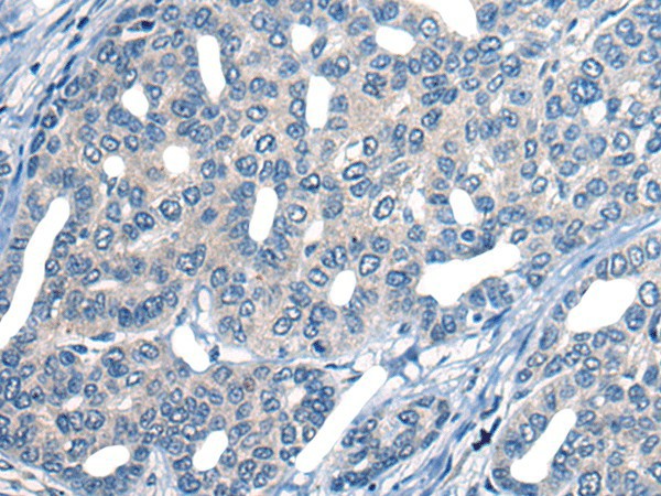 Immunohistochemistry of paraffin-embedded Human liver cancer tissue  using MARK2 Polyclonal Antibody at dilution of 1:25(?200)