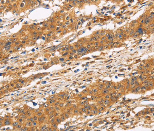 Immunohistochemistry of paraffin-embedded Human gasrtic cancer tissue using CD22 Polyclonal Antibody at dilution 1:50