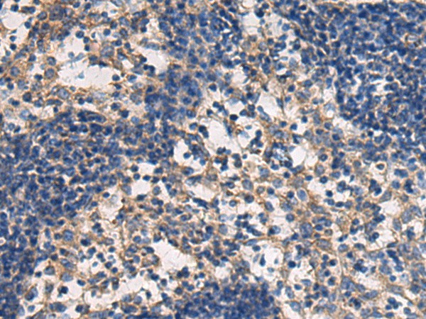 Immunohistochemistry of paraffin-embedded Human esophagus cancer tissue  using DMRTA2 Polyclonal Antibody at dilution of 1:50(?200)