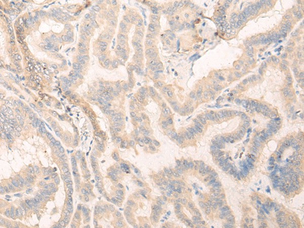 Immunohistochemistry of paraffin-embedded Human thyroid cancer tissue  using SEPT10 Polyclonal Antibody at dilution of 1:25(?200)