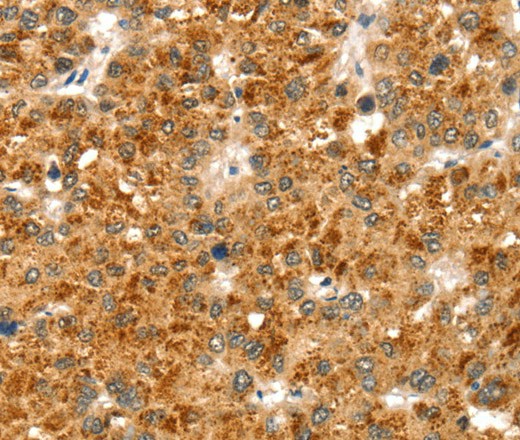 Immunohistochemistry of paraffin-embedded Human liver cancer using CCS Polyclonal Antibody at dilution of 1:35