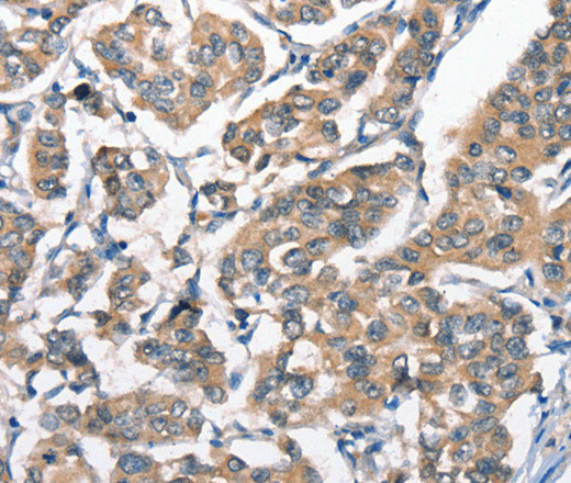 Immunohistochemistry of paraffin-embedded Human breast cancer tissue using HGF Polyclonal Antibody at dilution 1:65